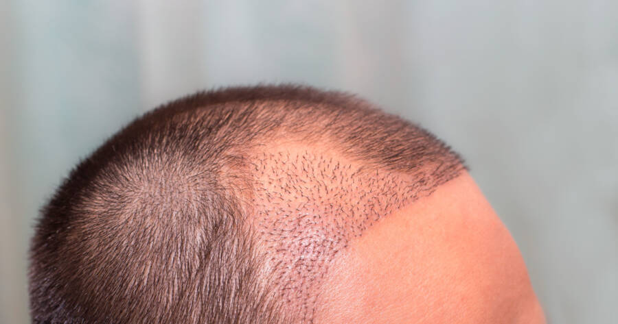 The Ultimate Guide to Hair Transplant Procedures: Costs and Locations Explained