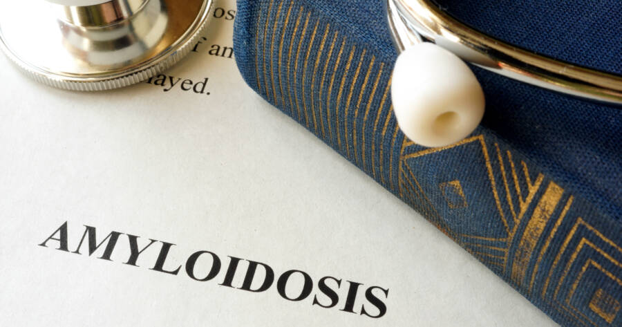 Amyloidosis: Symptoms and Treatment Options Everyone Should Know